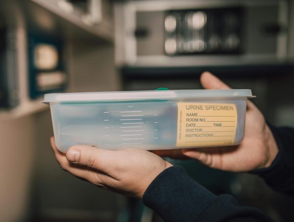 Urine sample collected in plastic container